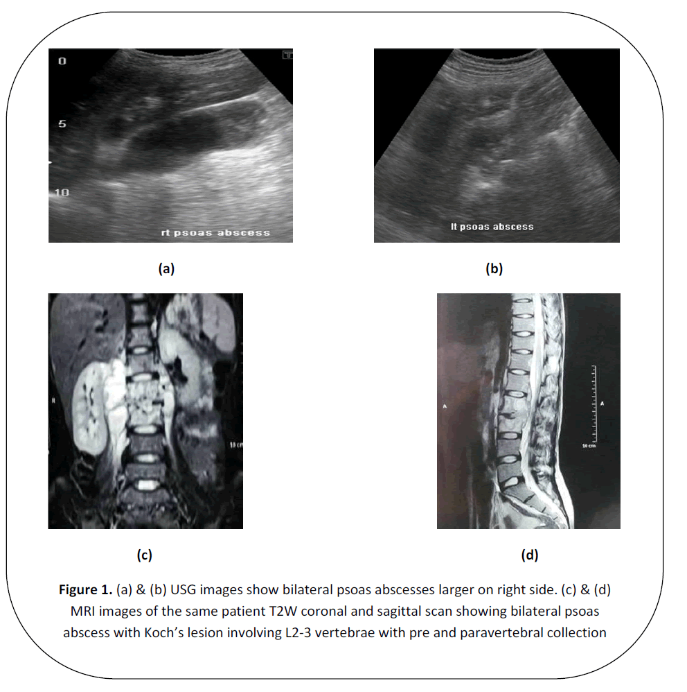 british-journal-research-bilateral-psoas-abscesses