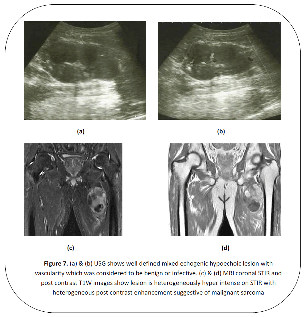 british-journal-research-echogenic-hypoechoic-lesion