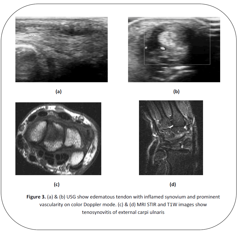 british-journal-research-edematous-tendon