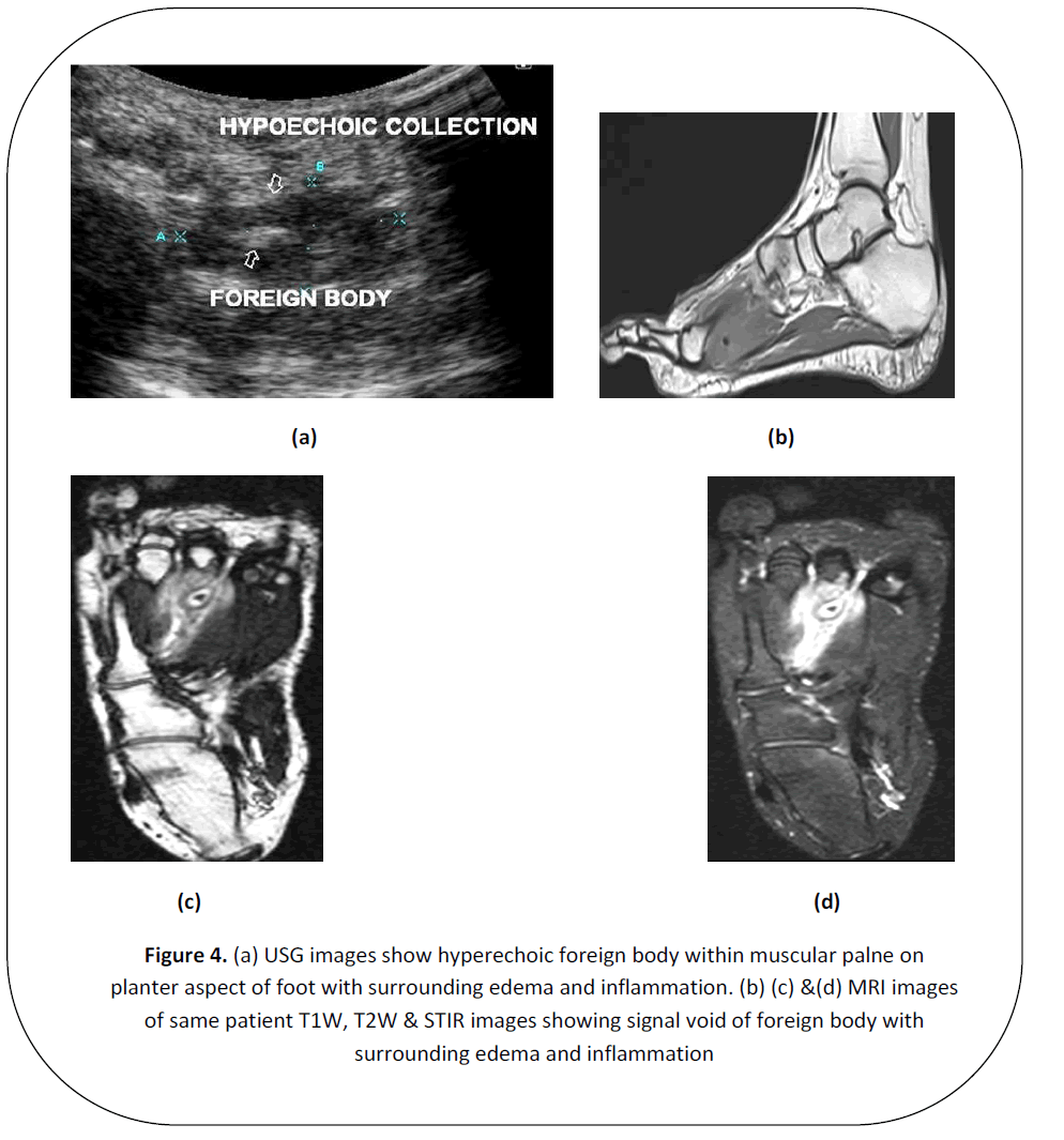 british-journal-research-hyperechoic-foreign-body