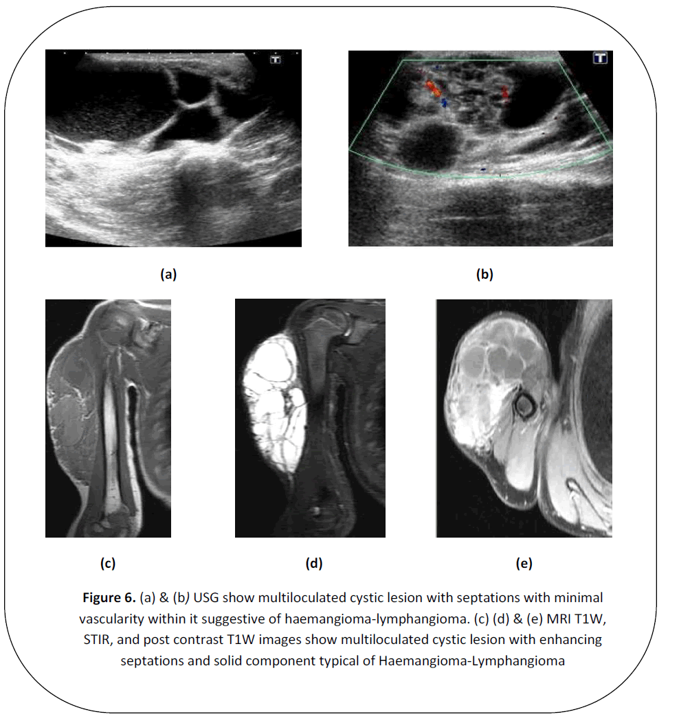 british-journal-research-multiloculated-cystic-lesion