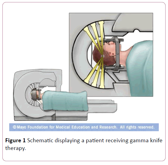 british-journal-research-patient-receiving-gamma-knife