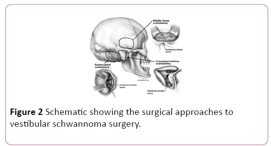 british-journal-research-vestibular-schwannoma-surgery