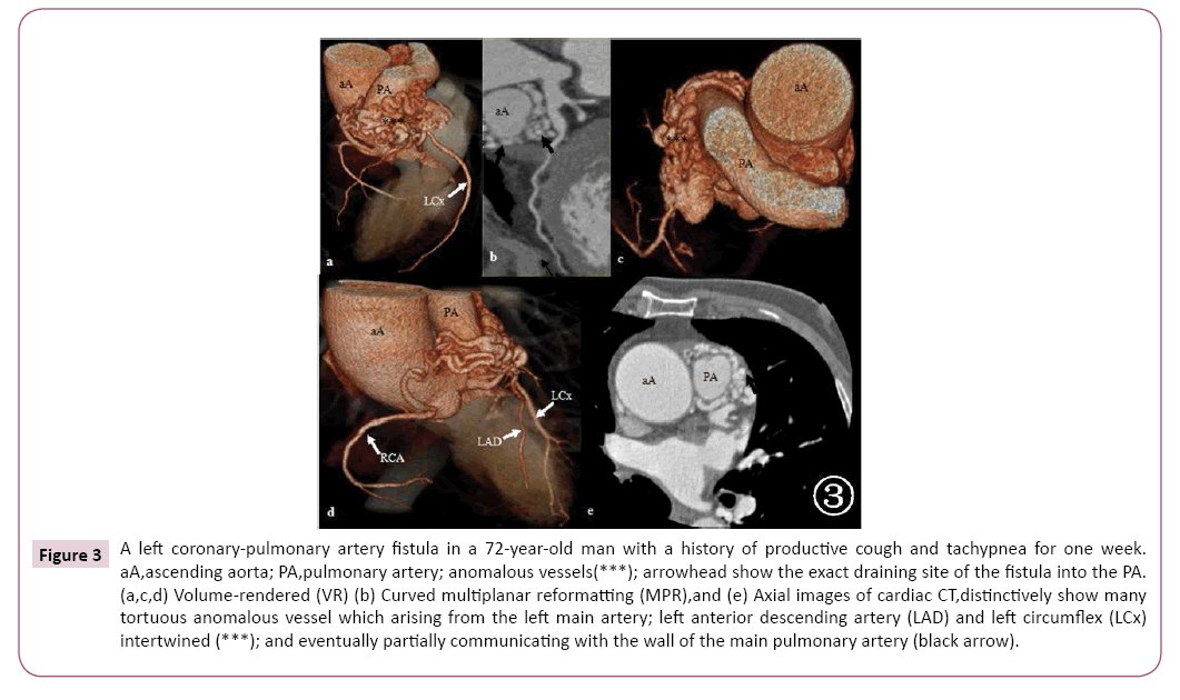 cardiovascular-investigations-open-access-artery-fistula