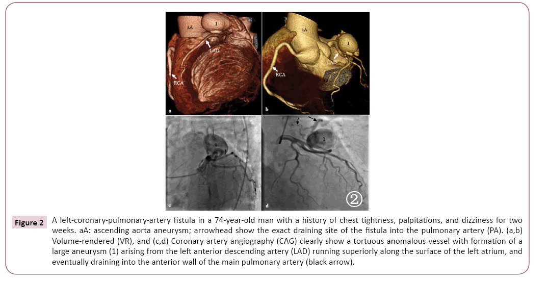 cardiovascular-investigations-open-access-left-coronary