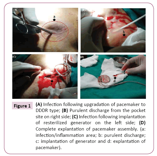 cardiovascular-investigations-open-access-pacemaker