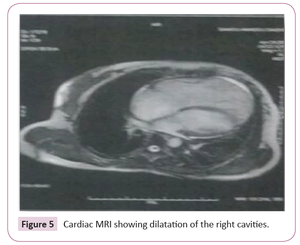 cardiovascular-investigations-open-access-showing-dilatation