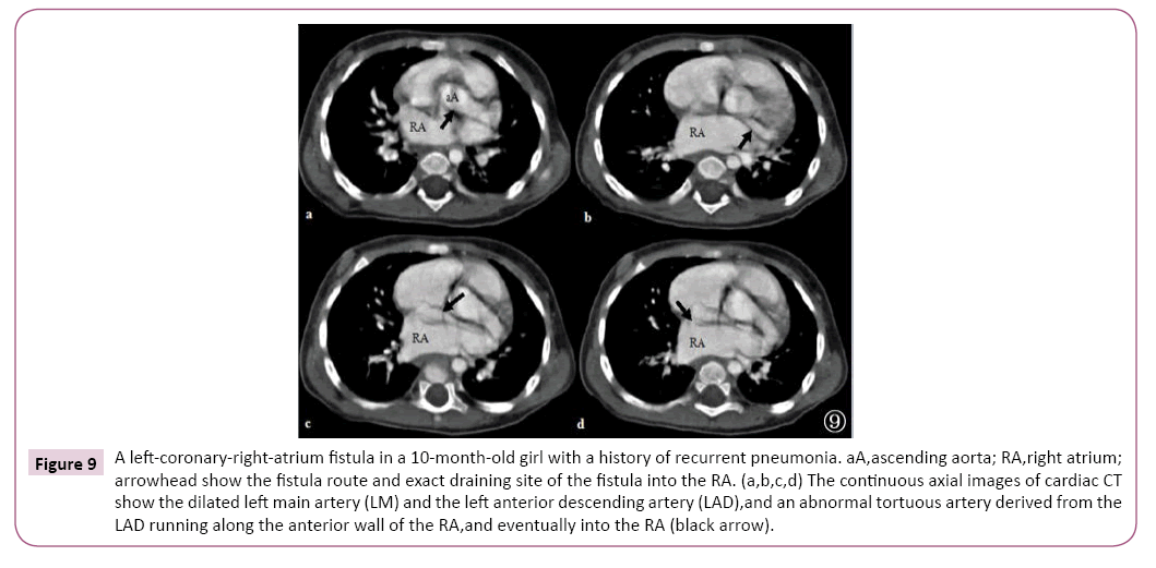 cardiovascular-investigations-open-access-tortuous