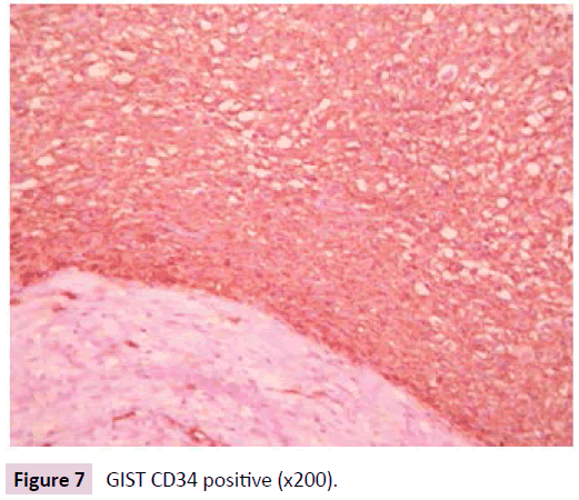 clinical-epigenetics-GIST-CD34-positive