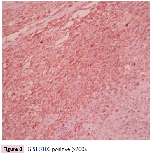 clinical-epigenetics-GIST-S100-positive