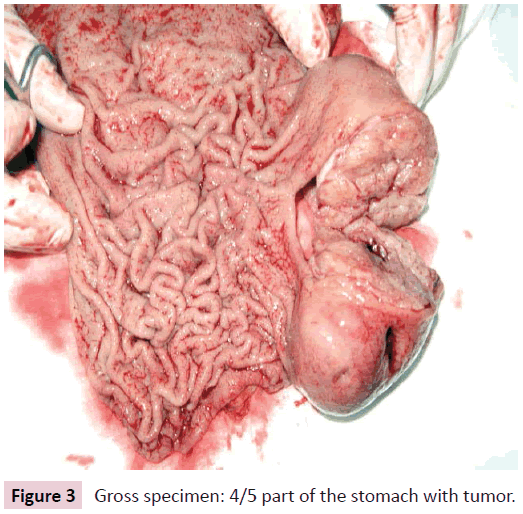 clinical-epigenetics-Gross-specimen