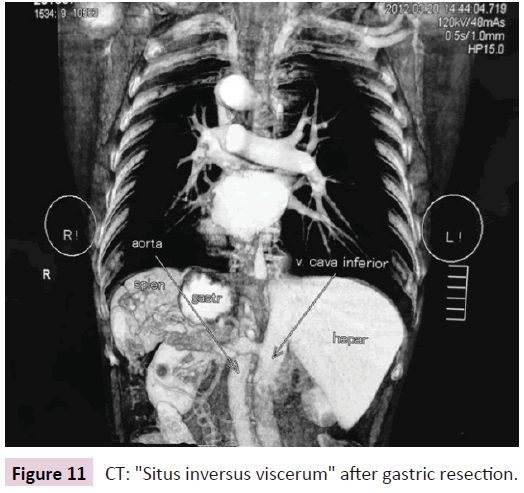 clinical-epigenetics-Situs-inversus-viscerum