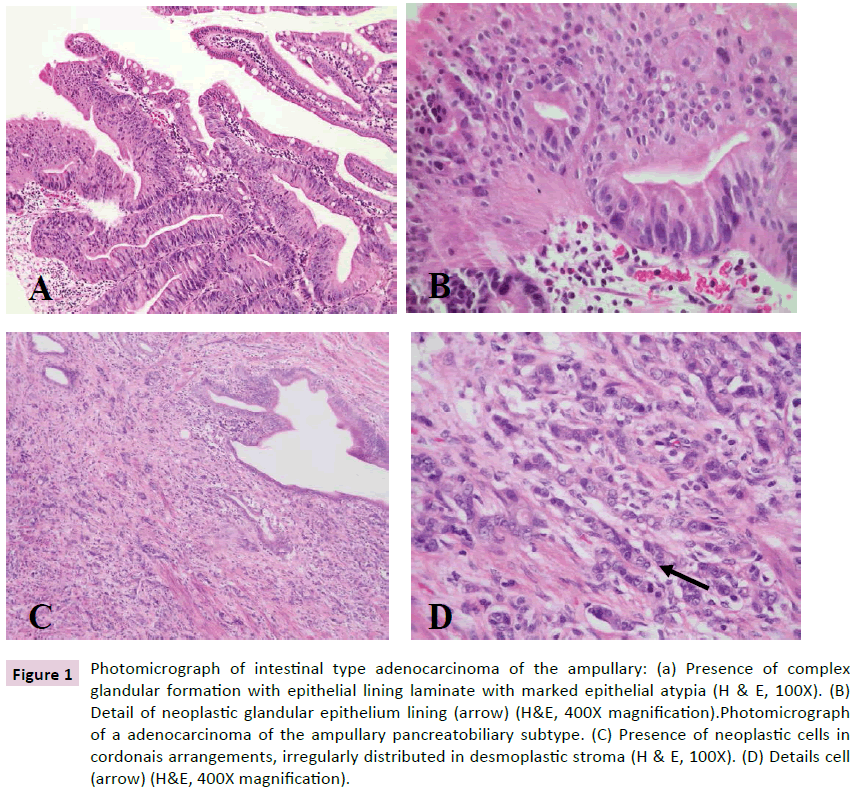 Carcinoma of Ampulla of Vater: Carcinogenesis and Immunophenotyp
