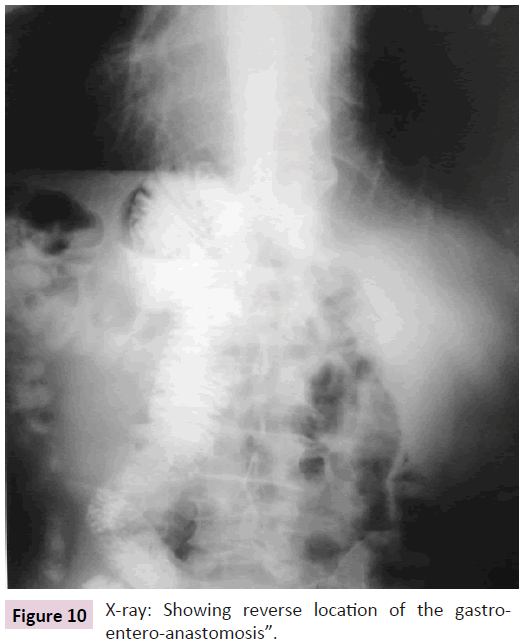 clinical-epigenetics-gastroentero-anastomosis