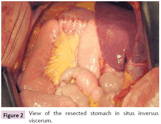 clinical-epigenetics-resected-stomach