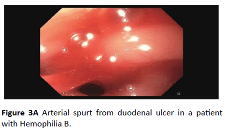 clinical-gastroenterology-hepatology-Arterial-spurt