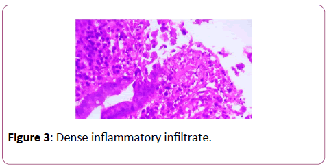 clinical-gastroenterology-hepatology-Dense-inflammatory