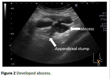 clinical-gastroenterology-hepatology-Developed-abscess