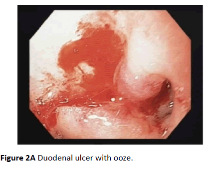 clinical-gastroenterology-hepatology-Duodenal-ulcer
