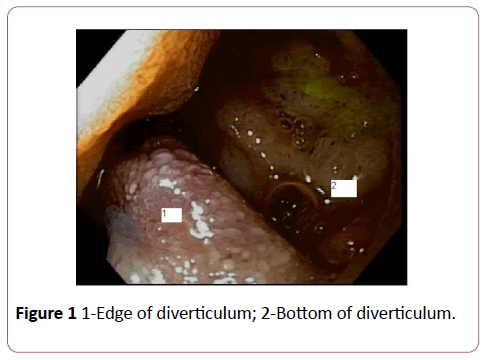 clinical-gastroenterology-hepatology-Edge-diverticulum