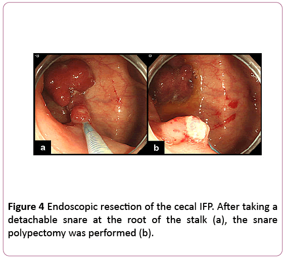 clinical-gastroenterology-hepatology-Endoscopic-resection