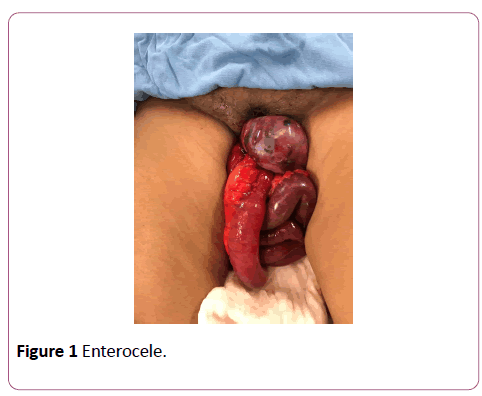 clinical-gastroenterology-hepatology-Enterocele