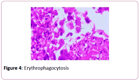 clinical-gastroenterology-hepatology-Erythrophagocytosis