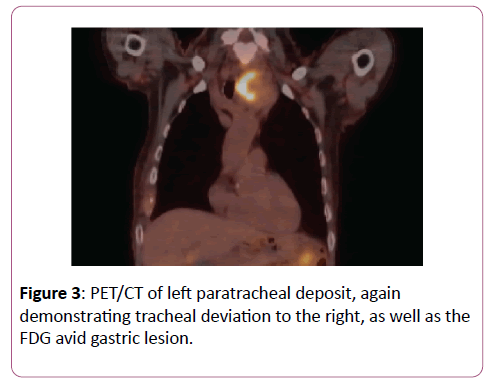 clinical-gastroenterology-hepatology-FDG-avid-gastric-lesion