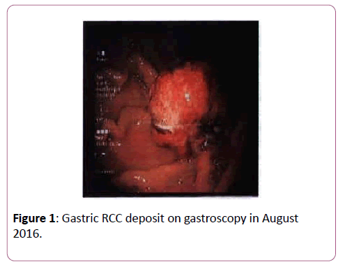 clinical-gastroenterology-hepatology-Gastric-RCC-deposit-gastroscopy