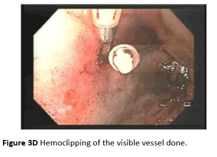 clinical-gastroenterology-hepatology-Hemoclipping