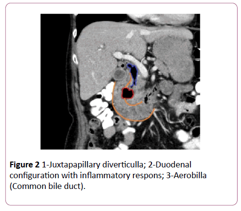 clinical-gastroenterology-hepatology-Juxtapapillary-diverticulla