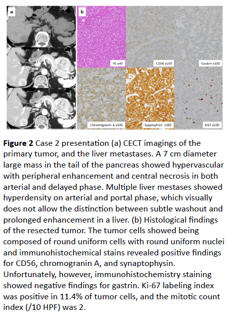 clinical-gastroenterology-hepatology-Multiple-liver-mestases