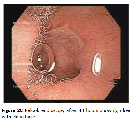 clinical-gastroenterology-hepatology-Relook-endoscopy