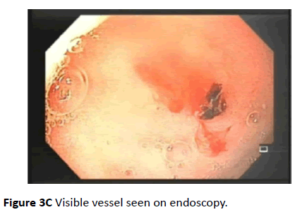 clinical-gastroenterology-hepatology-Visible-vessel