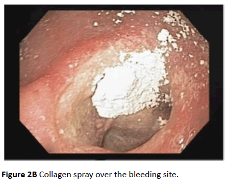 clinical-gastroenterology-hepatology-bleeding-site