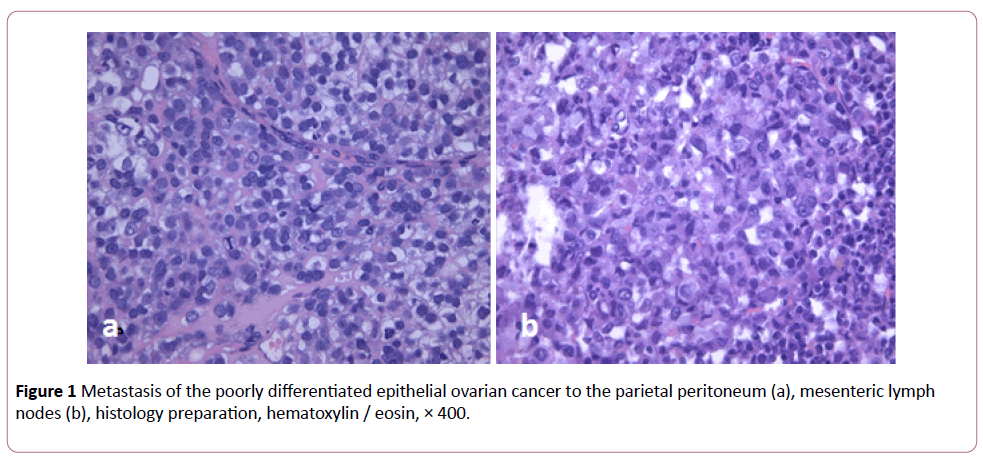 clinical-gastroenterology-hepatology-epithelial-ovarian-cancer