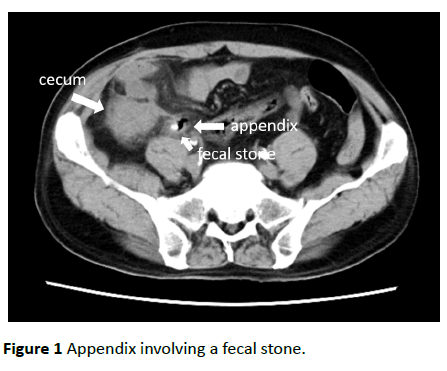 clinical-gastroenterology-hepatology-fecal-stone