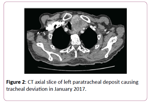 clinical-gastroenterology-hepatology-left-paratracheal-deposit-causing