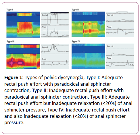 clinical-gastroenterology-hepatology-pelvic-dyssynergia