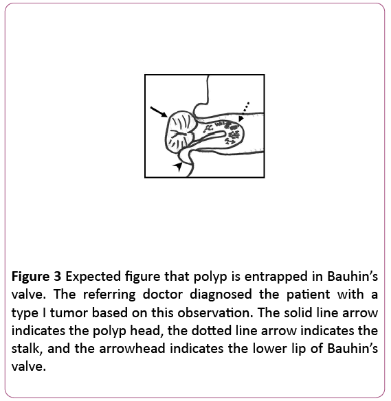 clinical-gastroenterology-hepatology-polyp-entrapped