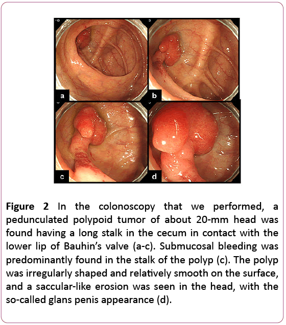 clinical-gastroenterology-hepatology-polypoid-tumor