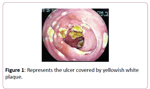 clinical-gastroenterology-hepatology-ulcer-covered