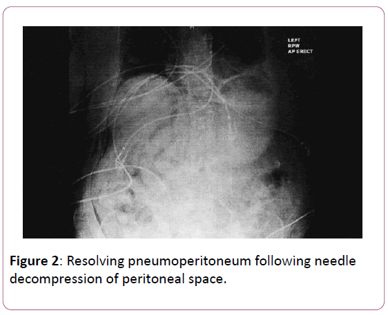 clinical-gastroenterology-pneumoperitoneum