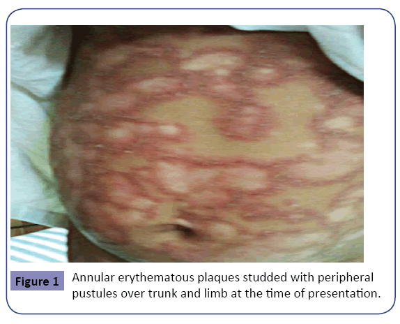 clinical-pediatrics-dermatology-Annular-erythematous