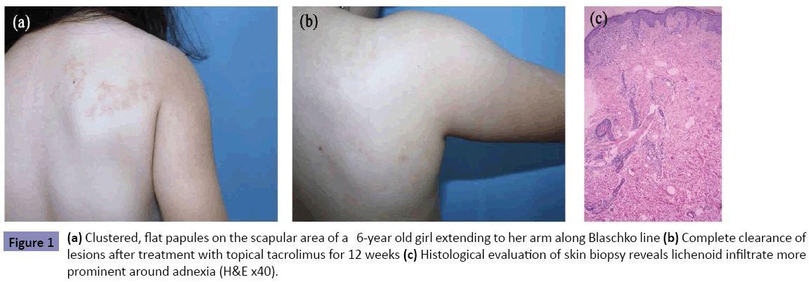 clinical-pediatrics-dermatology-Clustered-papules-scapular