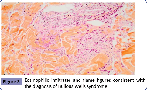 clinical-pediatrics-dermatology-Eosinophilic-infiltrates-Bullous