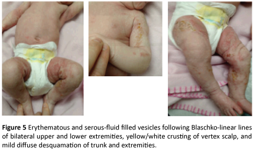 clinical-pediatrics-dermatology-Erythematous-serous-fluid