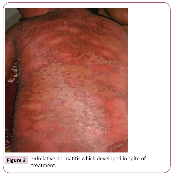 clinical-pediatrics-dermatology-Exfoliative-dermatitis