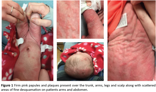 clinical-pediatrics-dermatology-Firm-pink-papules