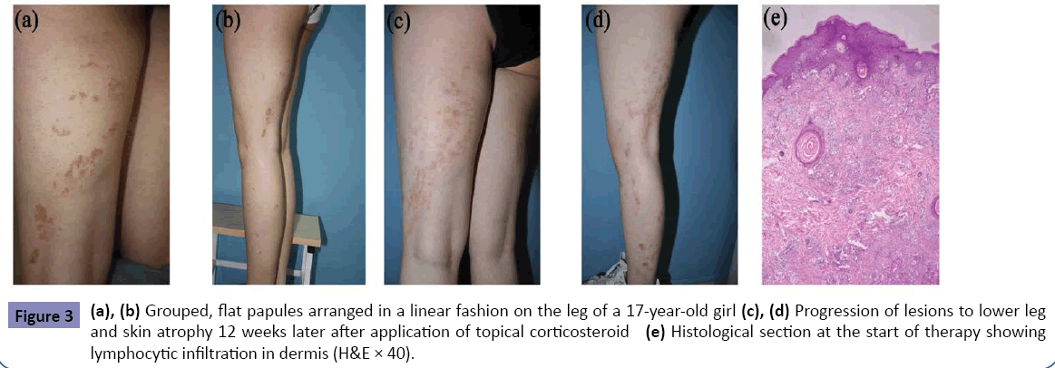 clinical-pediatrics-dermatology-Grouped-papules-linear